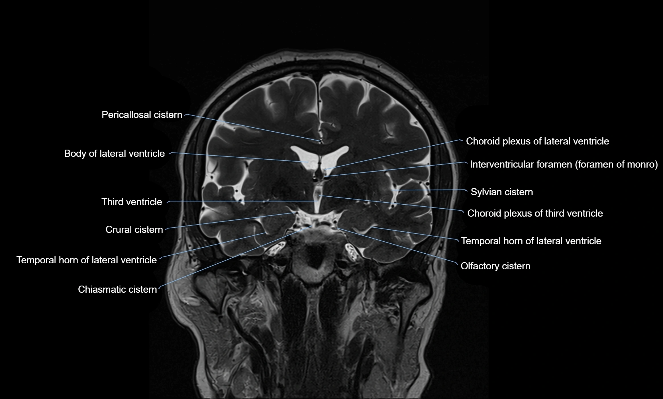 Brain cisterns  and ventricles coronal anatomy 3T MRI image-img-00001-00026.webp